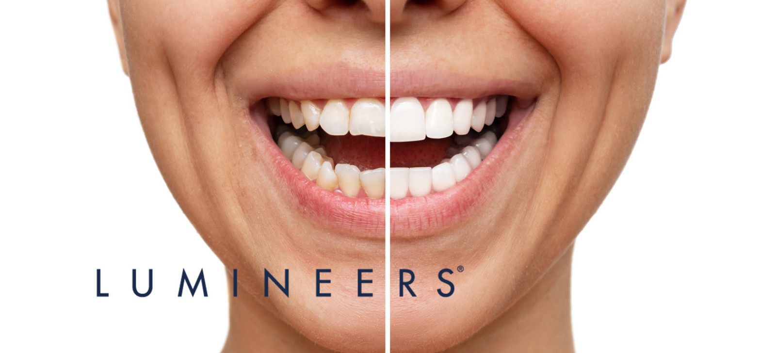 Facette Senza Preparazione: Lumineers e i Loro Vantaggi