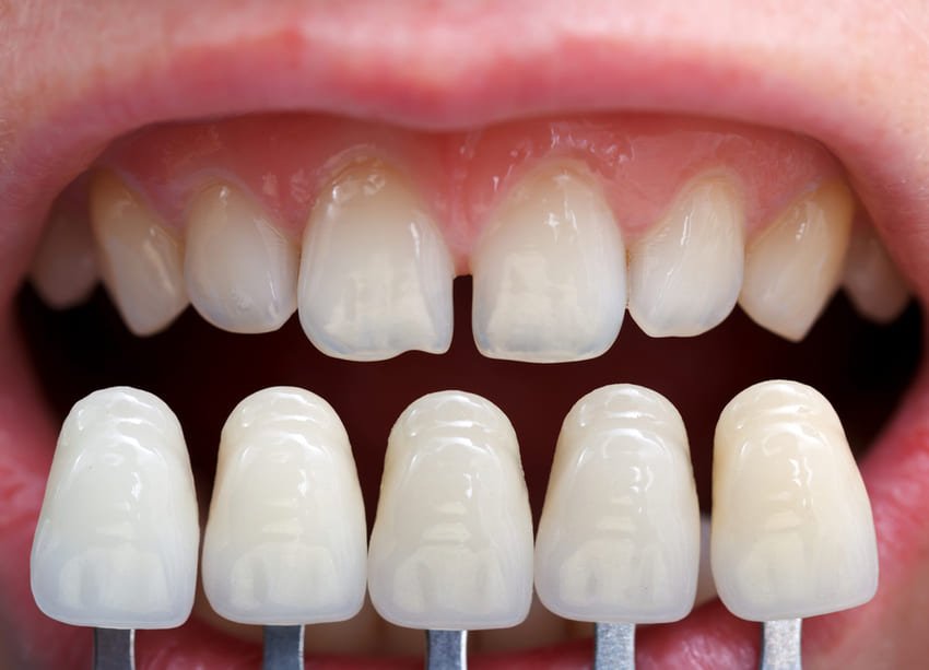 Faccette Lumineers: Trasforma il Tuo Sorriso alla Dental Family Bari