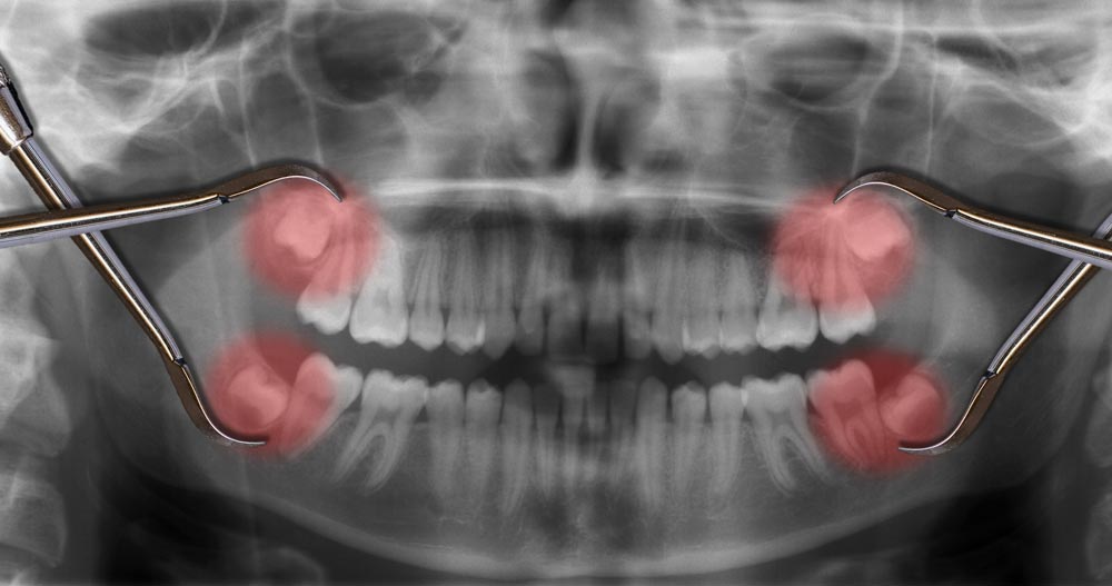 Dente del Giudizio: Guida all'Estrazione e Post-Operatorio