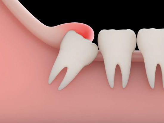 Dente del Giudizio: Storia e Problemi Nelle Nuove Generazioni